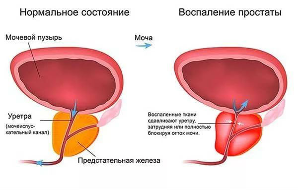 Мутная моча у мужчин и женщин: причины, почему мутнеет и с осадком