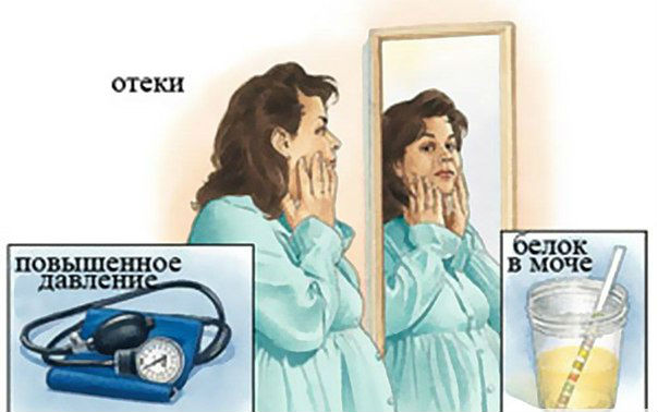 Белок в моче при беременности, причины и норма белка у беременных