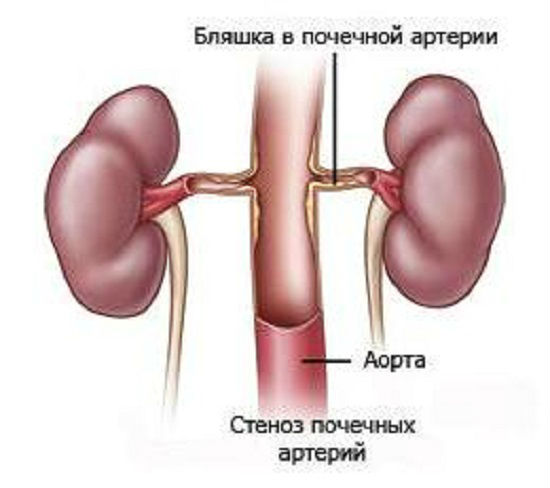 Симптомы почечной недостаточности: признаки, диагностика, как ее определить