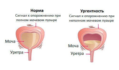 Императивные позывы к мочеиспусканию и недержание мочи