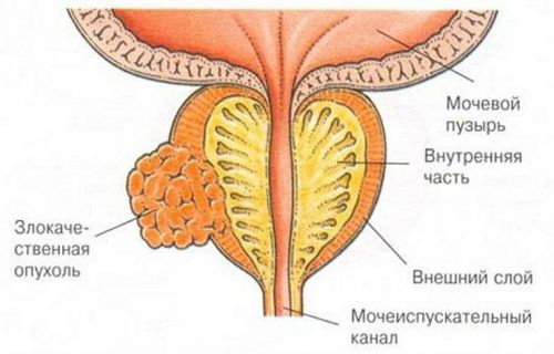 Моча темного цвета (темно-желтого): причины потемнения, что это значит