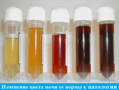 Моча темного цвета (темно-желтого): причины потемнения, что это значит