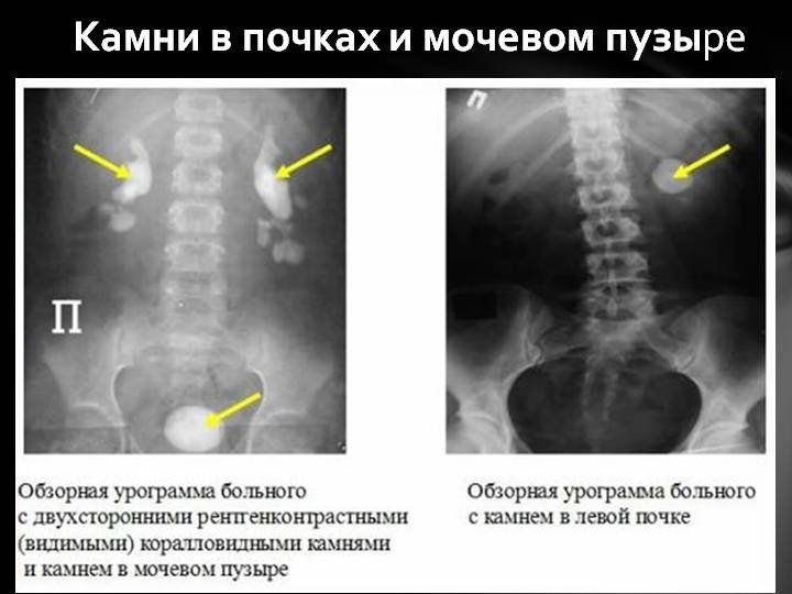 Обзорная урография почек: подготовка к процедуре и как она проводится