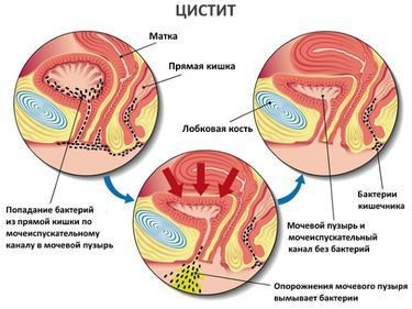 Жжение в мочеиспускательном канале (уретре) у женщин и мужчин: причины, лечение
