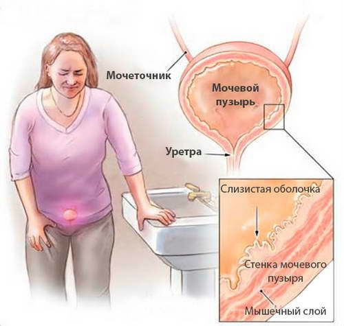 Жжение в мочеиспускательном канале (уретре) у женщин и мужчин: причины, лечение
