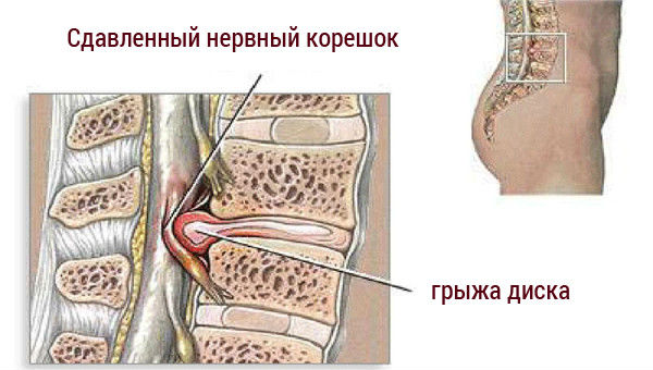 Болят почки или спина: как определить и узнать симптомы боли
