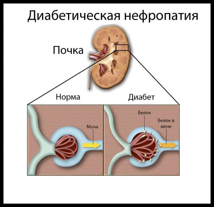 Микроальбумин в моче (анализ на МАУ): что это, как сдавать и собирать