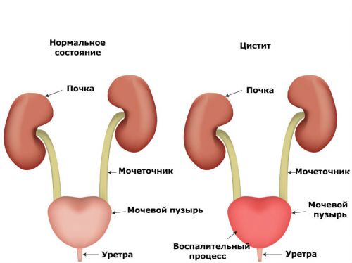 Подтекание мочи у женщин и мужчин: лечение, причины непроизвольных подтеков
