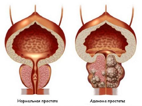 Частое мочеиспускание у мужчин без боли: причины и лечение