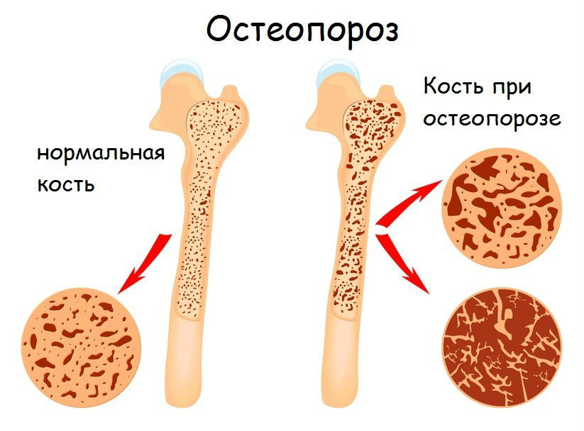 ДПИД утренней мочи: что это такое, почему повышен дезоксипиридинолин