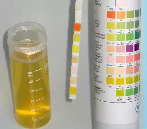 Общий анализ мочи: расшифровка результатов, таблица нормы у взрослых Общий анализ мочи: расшифровка результатов, таблица нормы у взрослых