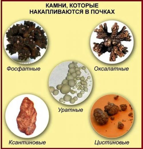 Общий анализ мочи: расшифровка результатов, таблица нормы у взрослых