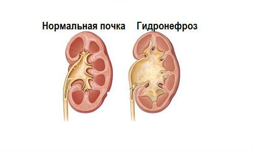Бактерии в моче при беременности: причины, лечение у беременных