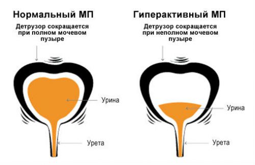 Детрузор мочевого пузыря: что это такое, его патологии