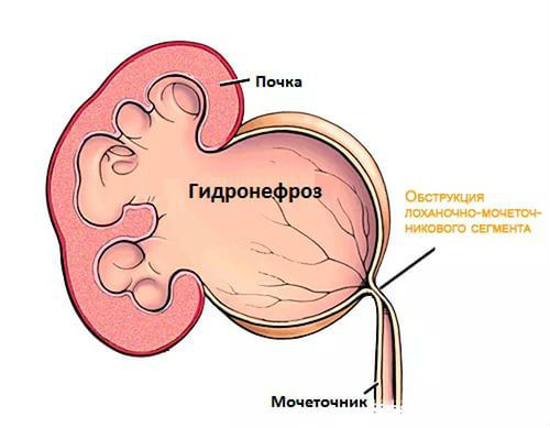 Мочеточник у женщин и мужчин, его строение (устье, отделы, диаметр и длина) Мочеточник у женщин и мужчин, его строение (устье, отделы, диаметр и длина)
