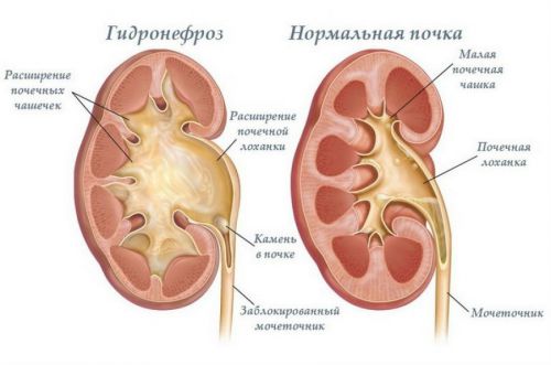 ЧЛС почек: что это такое, ее удвоение и расширение (левой и правой почки)