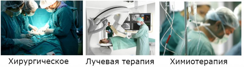 Лучевая терапия и химиотерапия: разница между облучением и химией, чем отличаются различные виды лечения и как проходит восстановление