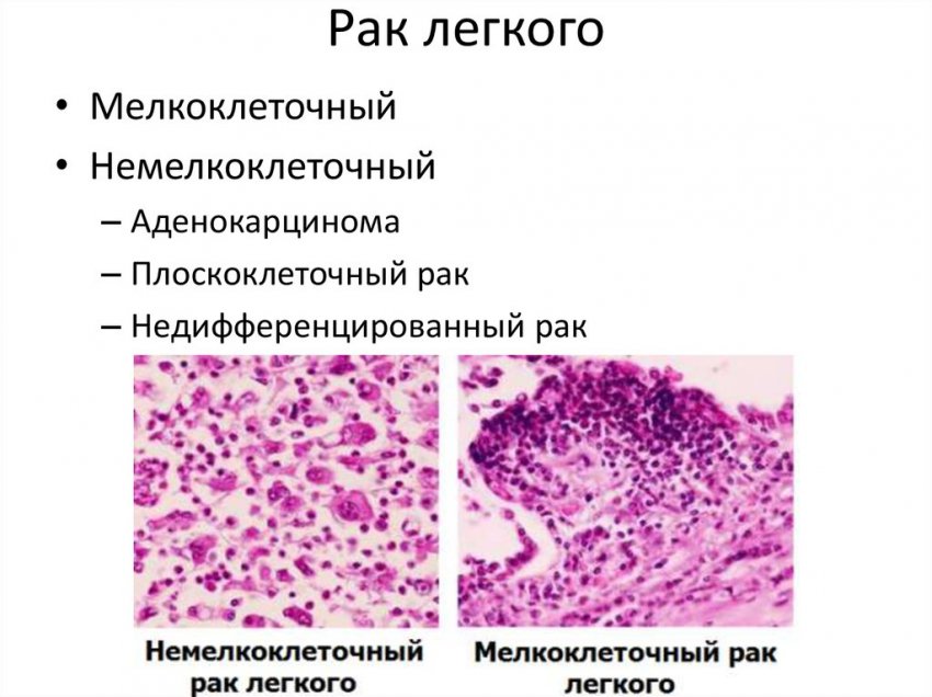 Плоскоклеточный рак легкого: виды, факторы риска и симптомы развития болезни, диагностика заболевания и прогноз выживаемости