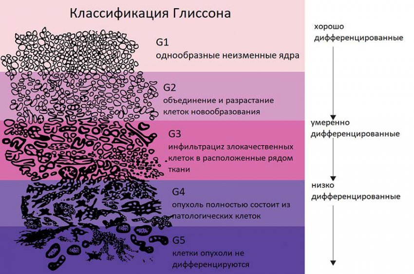 Аденокарцинома предстательной железы: виды, симптоматика и диагностика болезни, методы и схемы лечения