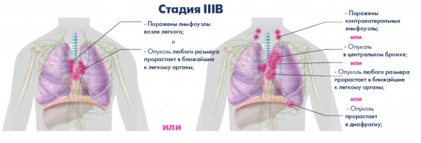 Аденокарцинома легкого: стадии и симптомы заболевания, диагностика паталогии, способы лечения и народная медицина в борьбе с недугом