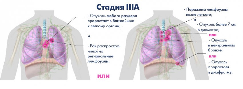 Аденокарцинома легкого: стадии и симптомы заболевания, диагностика паталогии, способы лечения и народная медицина в борьбе с недугом