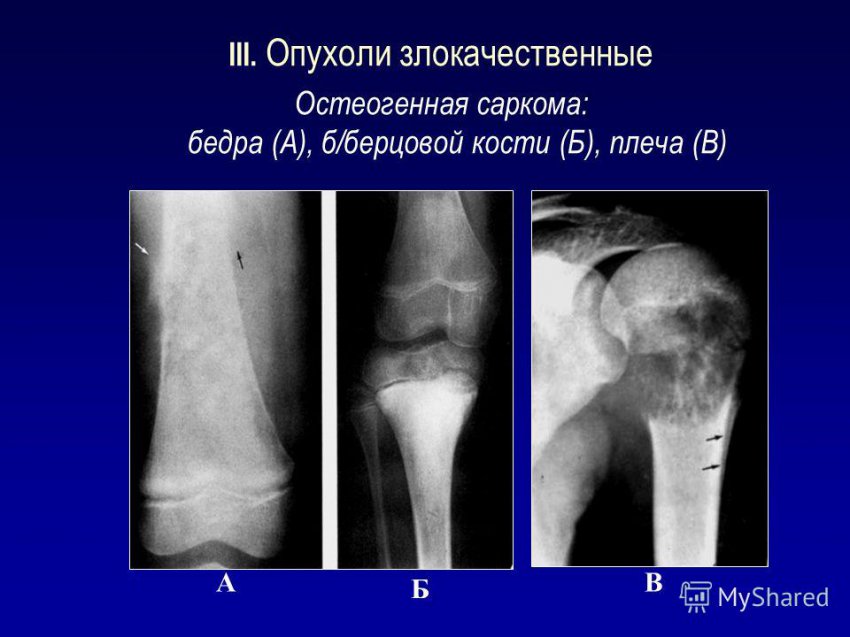Саркома кости: общие проявления и симптомы, причины заболевания, лечение костной опухоли