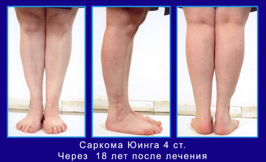 Саркома кости: общие проявления и симптомы, причины заболевания, лечение костной опухоли
