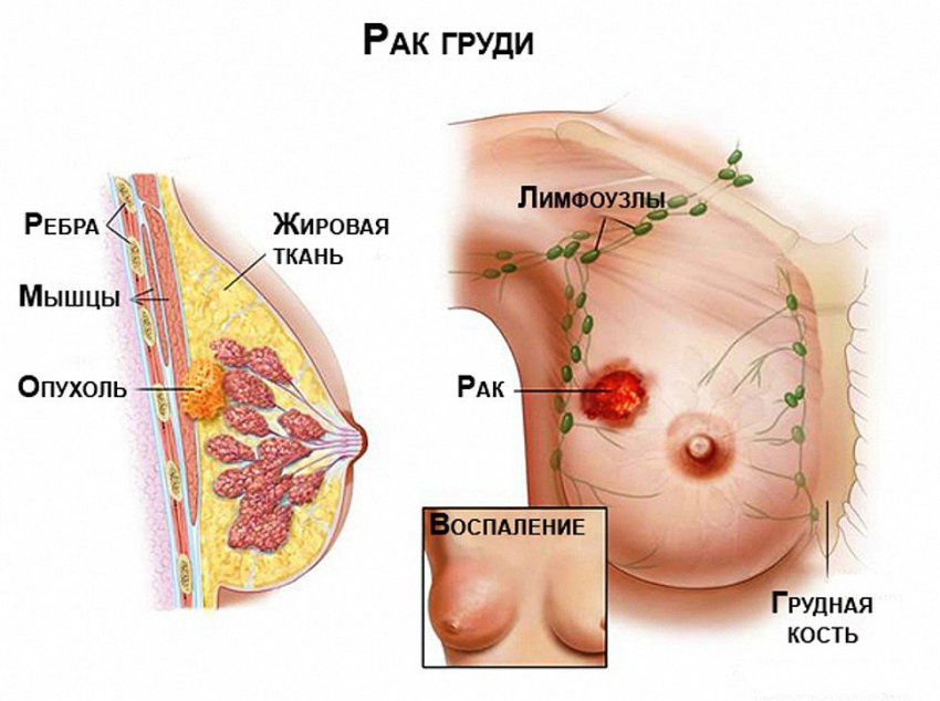 Болит ли грудь при раке: что происходит с тканями и методы борьбы, профилактика при неприятных ощущениях и советы врачей