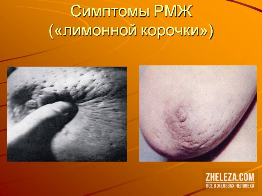 Инфильтративный рак молочной железы: что это, формы, симптомы, лечение и прогноз, какие факторы риска и прогнозы докторов
