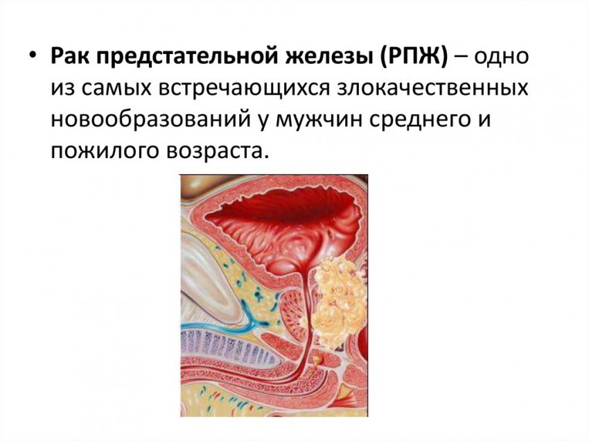 Рак предстательной железы 2 степени: особенности и симптоматика заболевания, причины возникновения, осложнения и прогноз