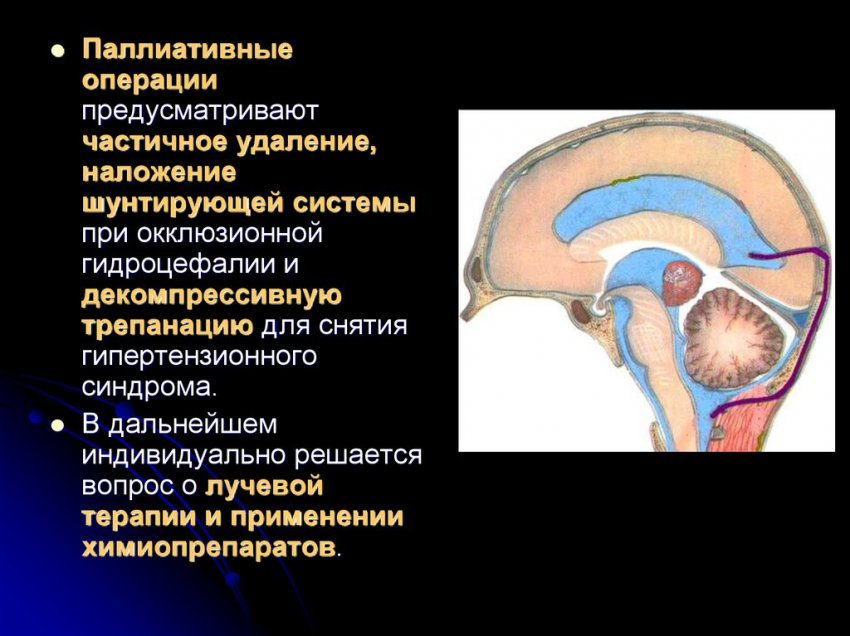 Астроцитома головного мозга: что это такое, методы лечения заболевания, причины формирования опухоли, симптомы мозговых нарушений