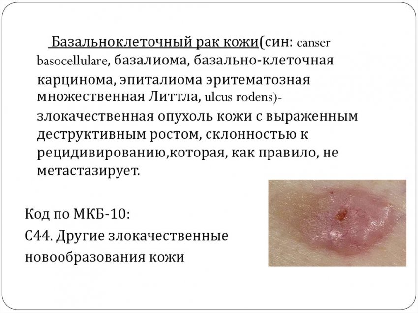 Базалиома кожи: код по МКБ 10, симптомы и лечение, стадии заболевания