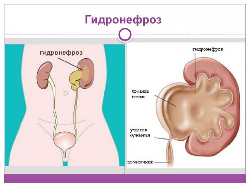 Заболевание почек у мужчин: симптомы и лечение таких болезней