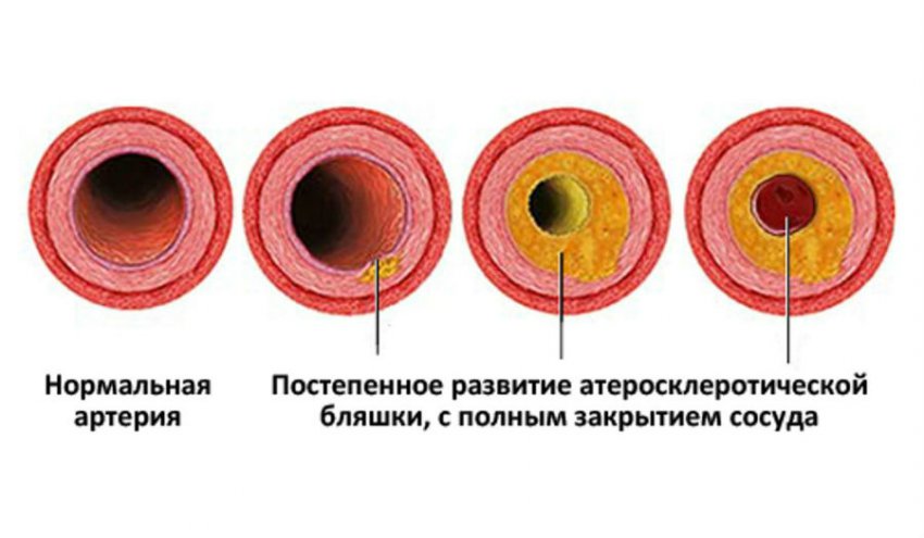 Как снизить почечное давление в домашних условиях (понизить его дома)
