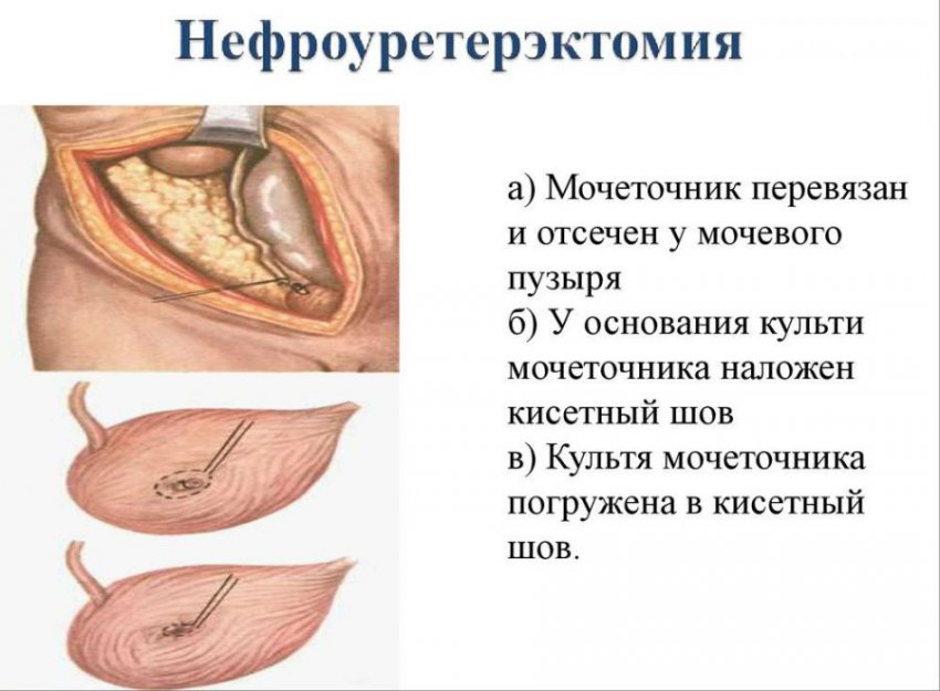Рак мочеточника у женщин и мужчин: симптомы, причины