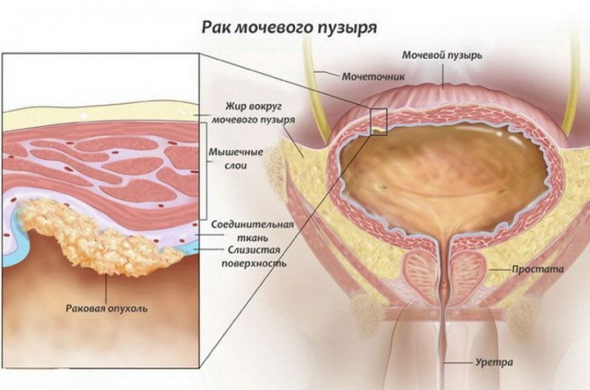 Цистит с кровью у женщин: лечение препаратами, симптомы, причины крови в моче