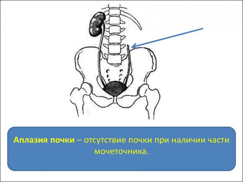 Аплазия почки (правой или левой): что это такое, причины у детей
