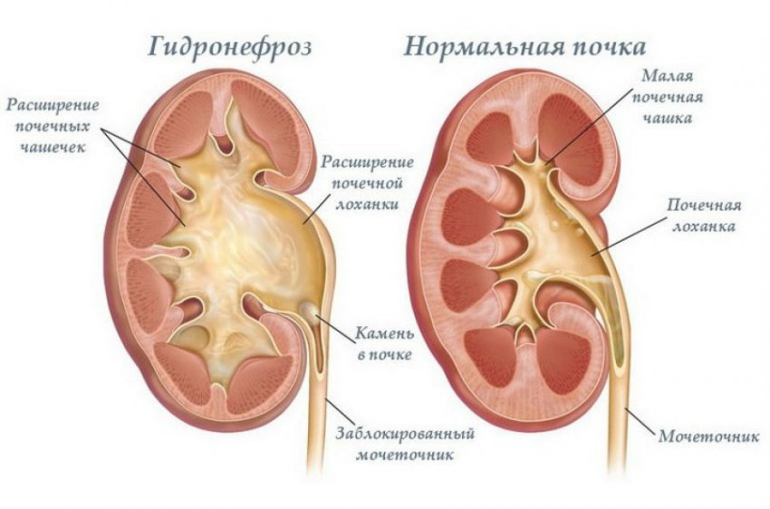Раздвоение почки: что это такое и чем оно грозит