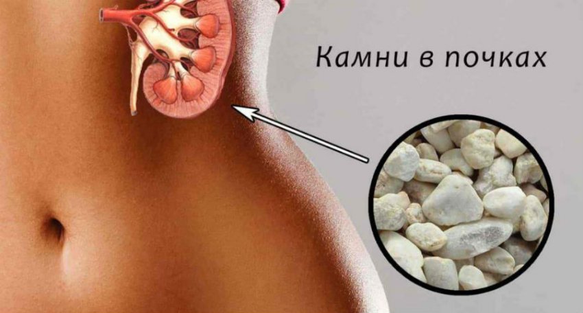 Почечная колика: как снять боль, лечение, что делать при приступе