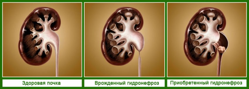 Почему болят почки и повышается температура, что с этим делать
