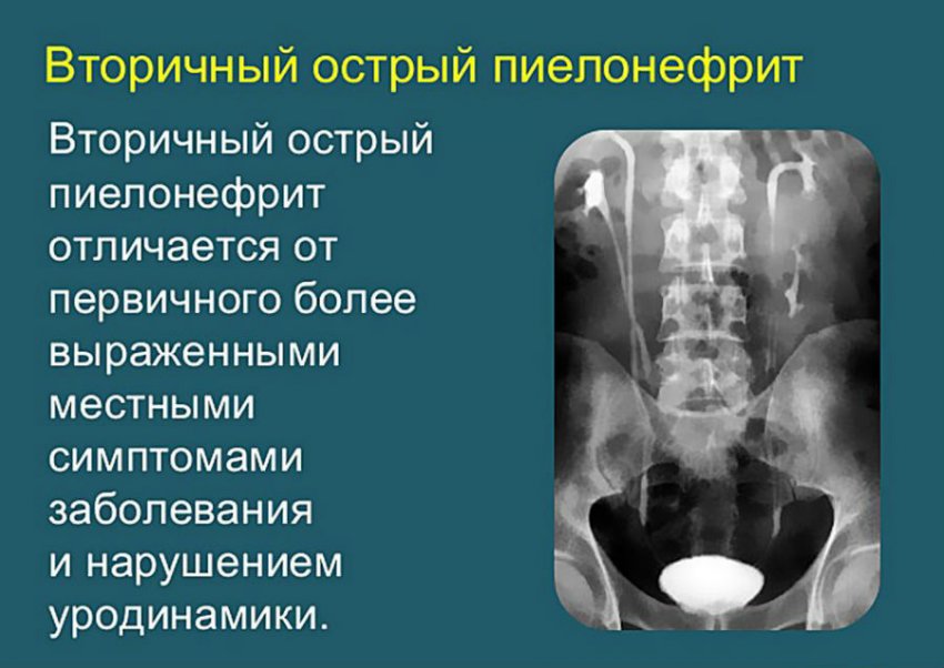Острый пиелонефрит у детей: симптомы, лечение и причины