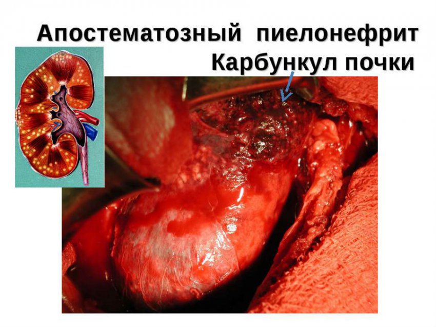 Карбункул почки: что это, лечение, симптомы и причины