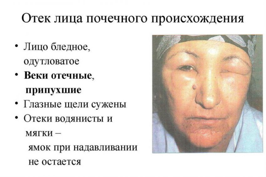 Очищение почек в домашних условиях народными средствами