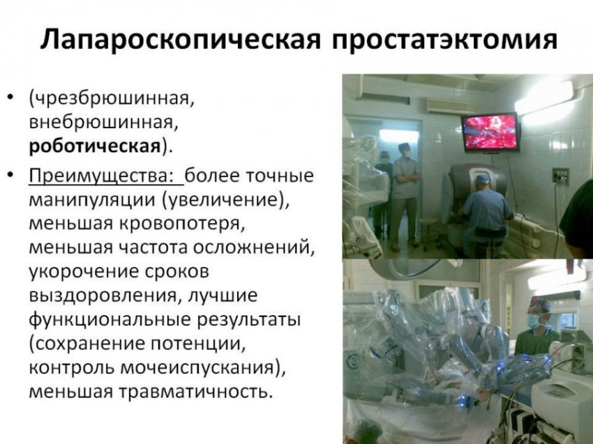 Операция по удалению простатита у мужчин: особенности, подготовка, реабилитация