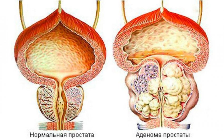 Вапоризация аденомы простаты: отзывы, особенности процедуры