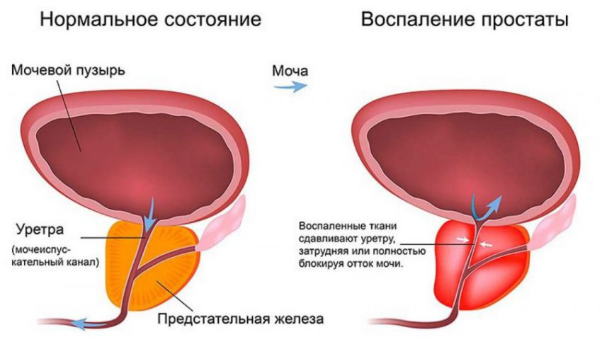 Лечение аденомы простаты народными средствами, самые эффективные методы