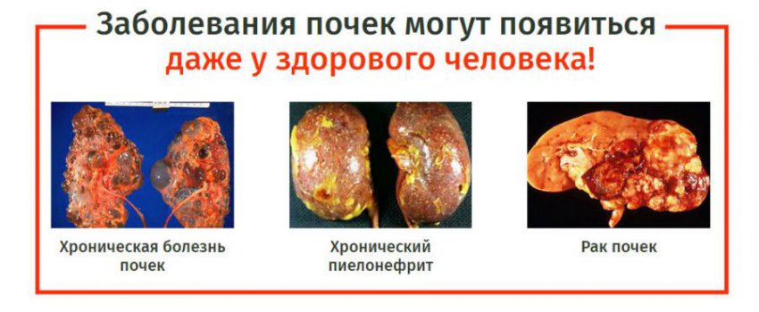 Что делать, когда болят почки: как снять и облегчить боль, первая помощь