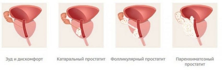 Температура при простатите: может ли быть у мужчин, причины