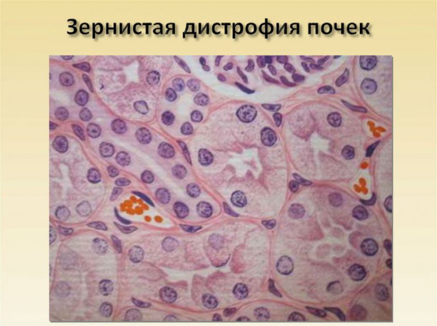 Зернистая дистрофия почки, эпителия извитых канальцев