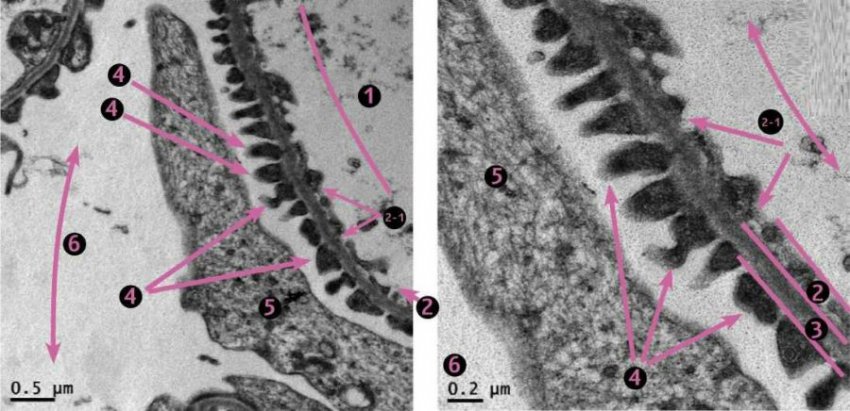 Гиперстенурия: причины, симптомы и диагностика